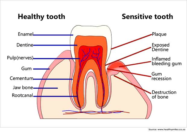 mengobati gigi sensitif